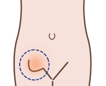 鼠径ヘルニアの説明イラスト