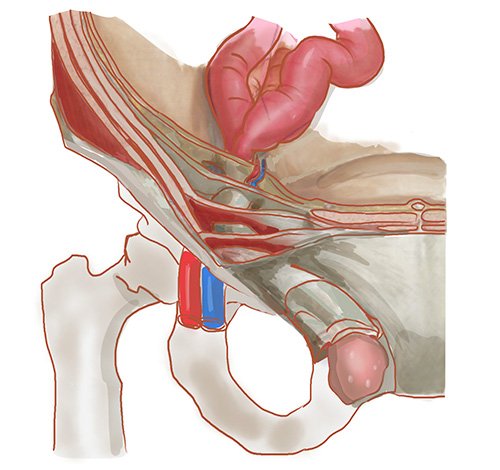 鼠径ヘルニアの解剖図