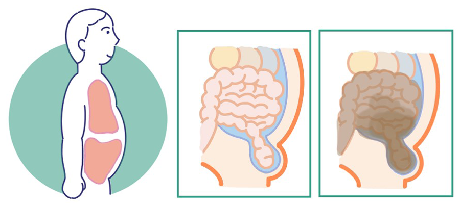 嵌頓のイメージ図