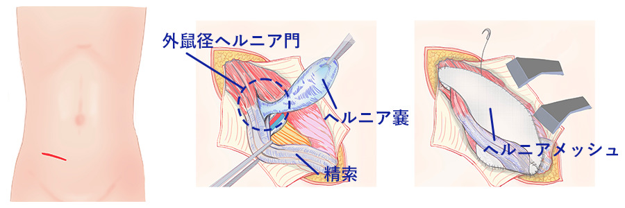 鼠径部切開法の解説図