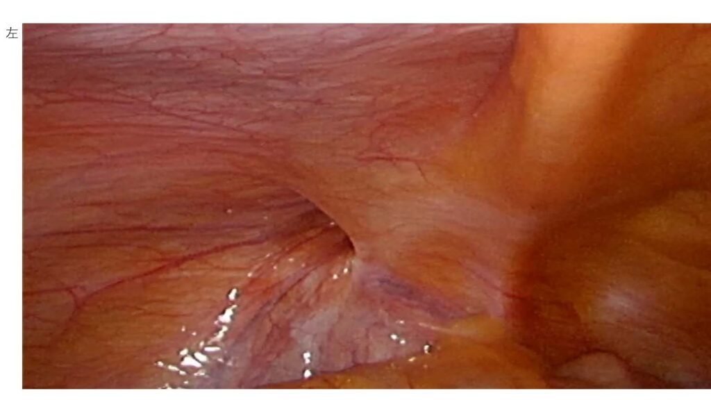 鼠径ヘルニアの腹腔鏡写真(左)