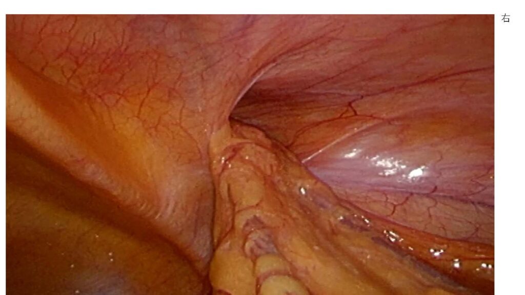 鼠径ヘルニアの腹腔鏡写真(右)