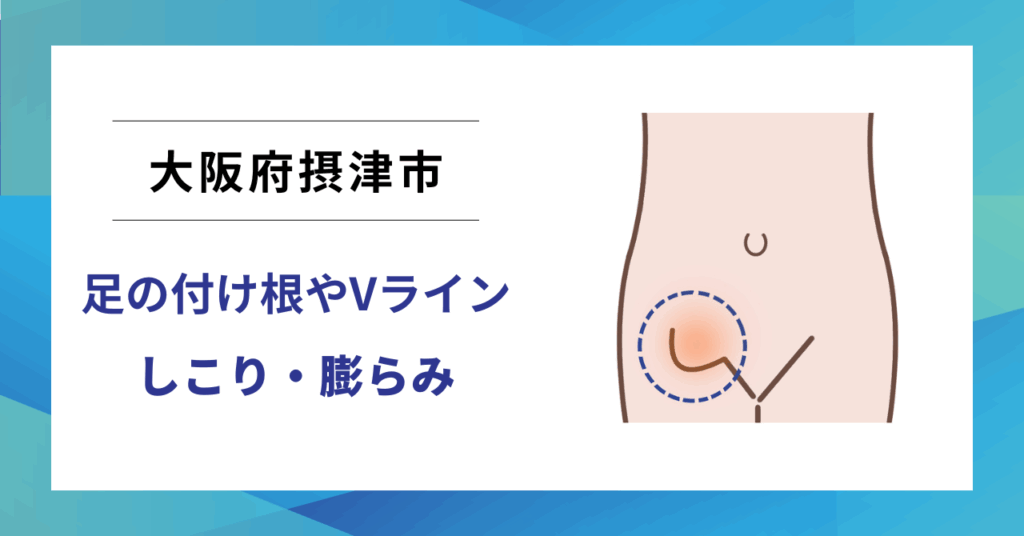 大阪府摂津市で鼠径ヘルニア（脱腸）の専門治療なら