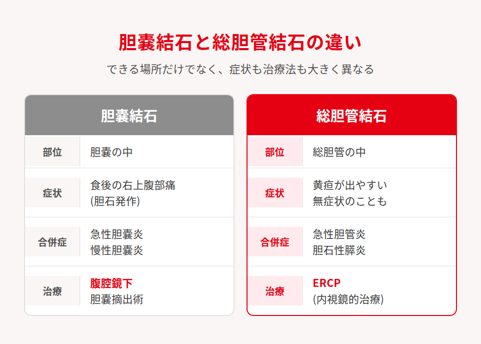 結石の違い