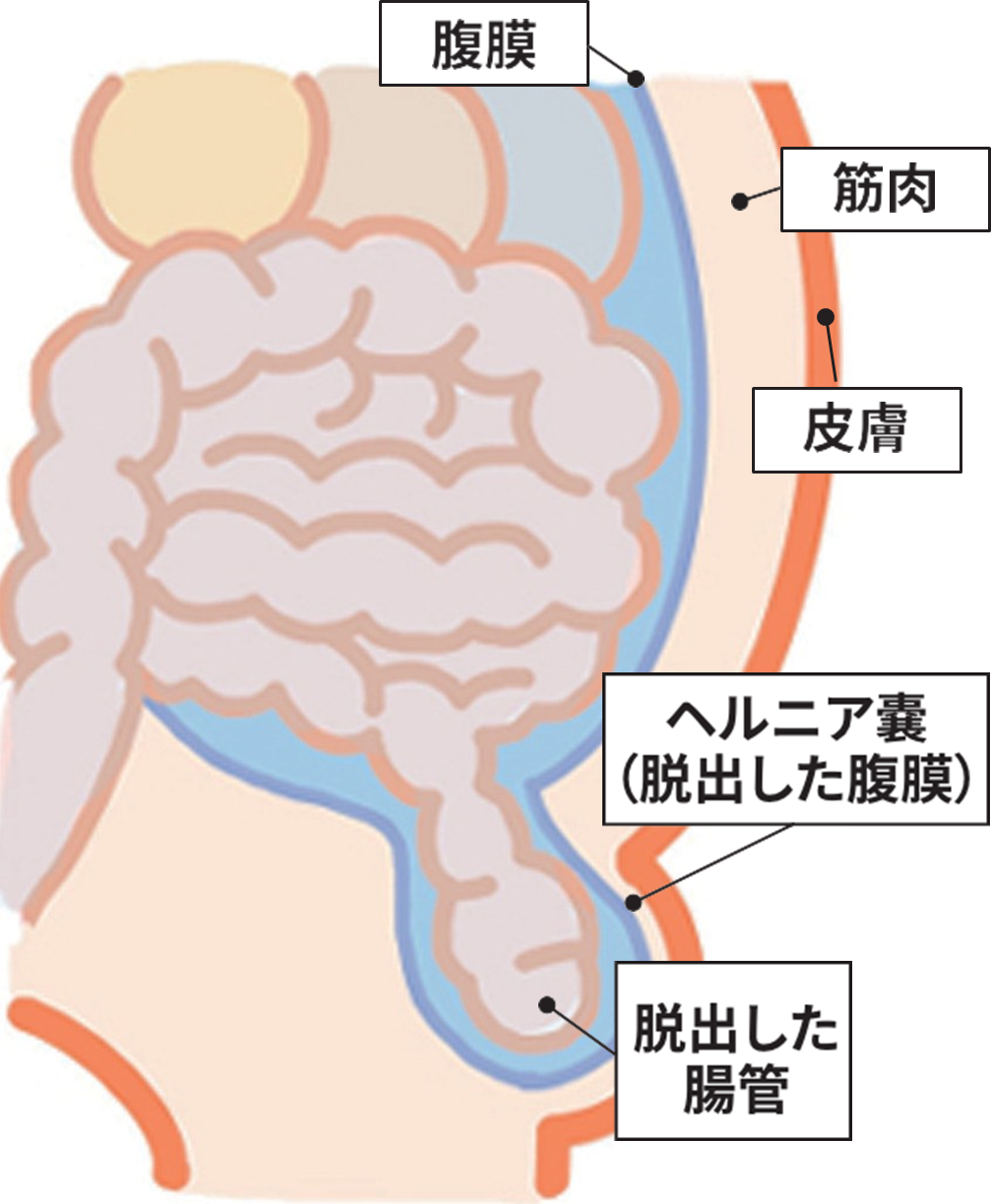鼠径ヘルニアの図