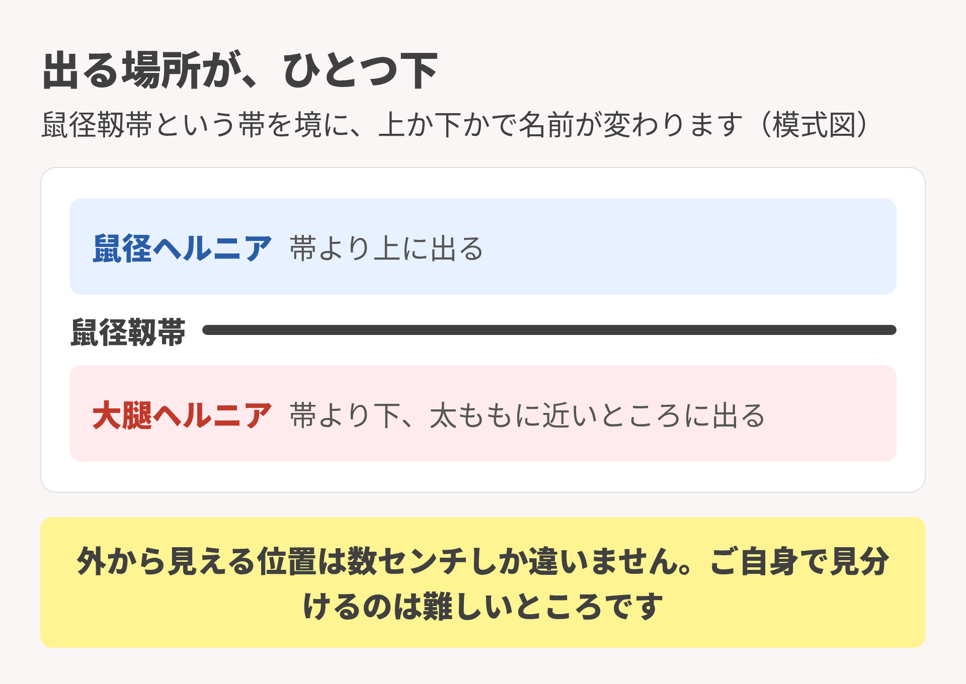 大腿ヘルニアと鼠径ヘルニアの出る場所の違い（見た目の位置）