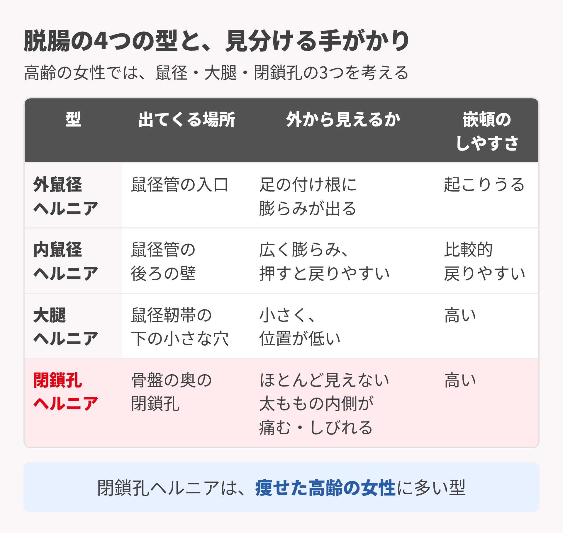 脱腸の4つの型と見分ける手がかり